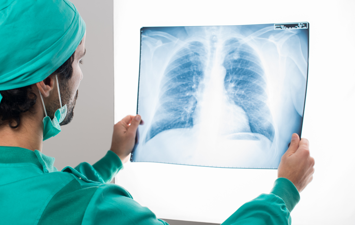 A doctor is conducting research on lung cancer.